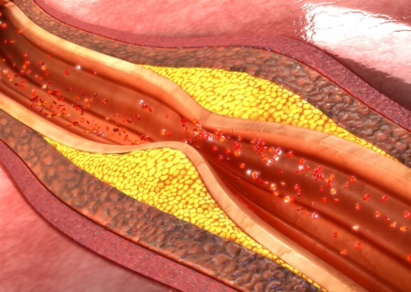 نانوذرات نوین با سکته قلبی مقابله می کنند