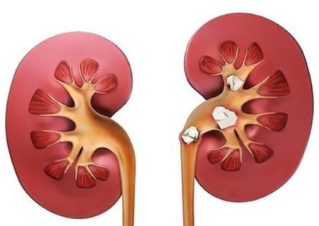 اخبار پزشکی| بیماری مزمن کلیه نهمین علت مرگ در جهان شد/ ۸۰درصد صادرات دارویی ایران محصولات بیوتک است