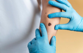 داروی درمان سرطان پوست از فاز انسانی سربلند بیرون آمد